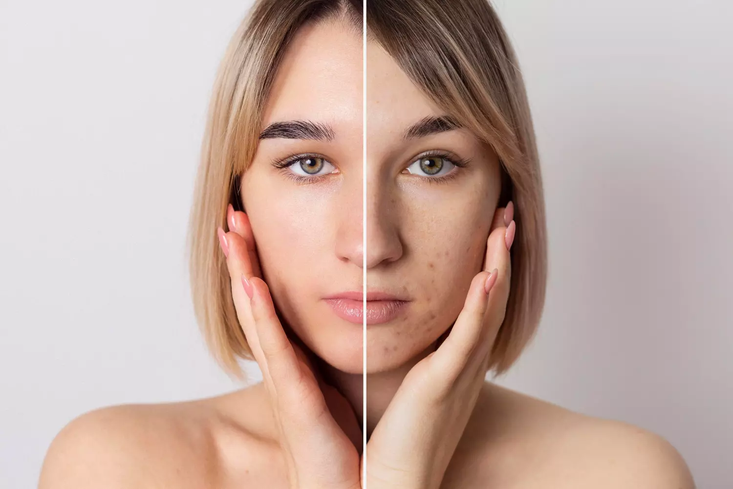 Anti-Acne Program. Санаторий Нехама один из лучших в регионе